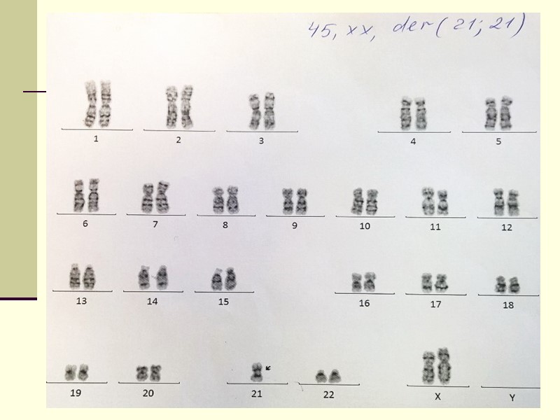 реципрокная транслокация t(9;22)(q34;q11) Первой хромосомной аберрацией, обнаруженной в опухолевых клетках человека, была филадельфийская хромосома,